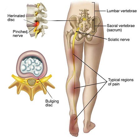 Sciatica Treatment Doctor Back Pain Specialist NYC