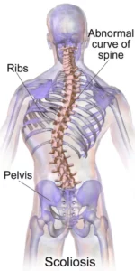 Scoliosis e1662129101321 512x1024 1